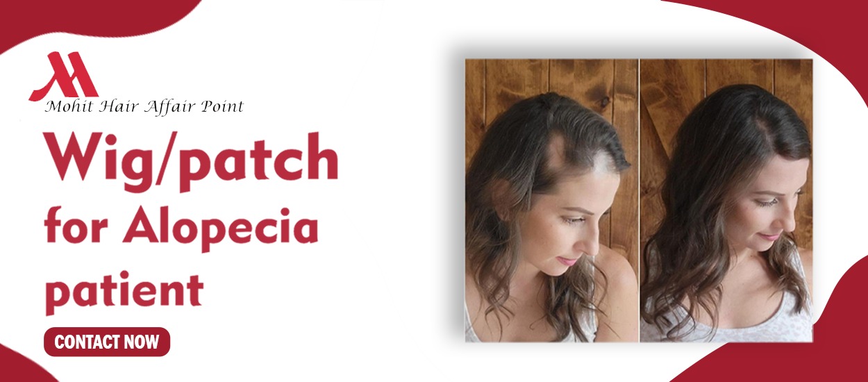 wig patch elopecia
